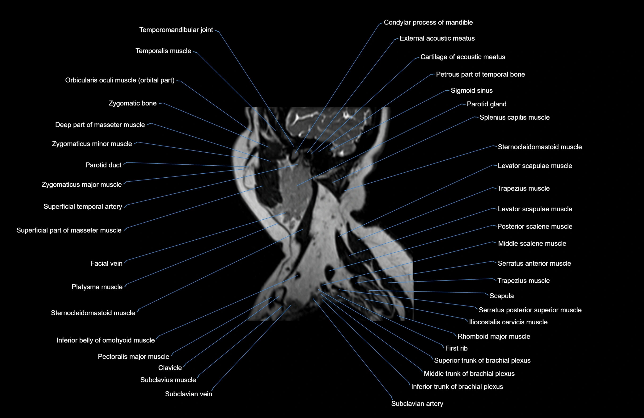 Neck MRI sagittal cross sectional anatomy 3D 1mm 3T radiology  image-img-00001-00033.webp